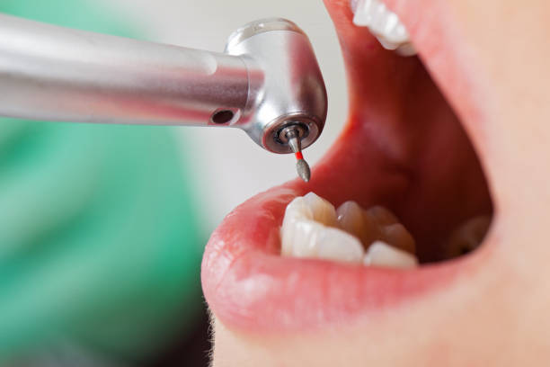 Best Emergency Tooth Extraction in Georgetown, CA